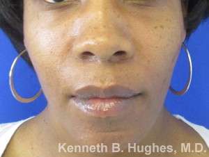Chin Implant Before & After Patient #8296
