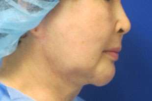Chin Implant Before & After Patient #8299