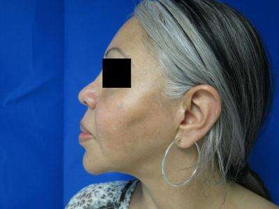 Chin Implant Before & After Patient #8307