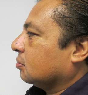 Chin Implant Before & After Patient #8317