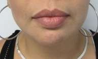 Chin Implant Before & After Patient #8322