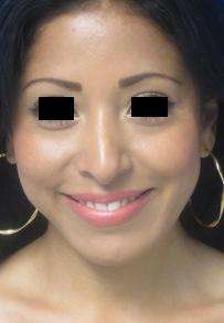 Chin Implant Before & After Patient #8327