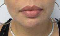 Chin Liposuction Before & After Patient #8340