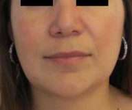Chin Liposuction Before & After Patient #8345