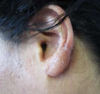 Ear Correction Before & After Patient #8354