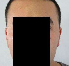 Ear Correction Before & After Patient #8357