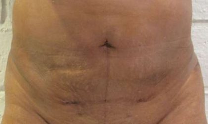 Bodytite Before & After Patient #6124