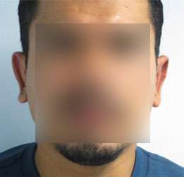 Ear Correction Before & After Patient #8360