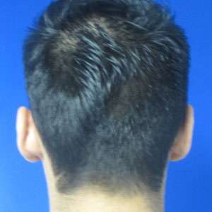 Ear Correction Before & After Patient #8366