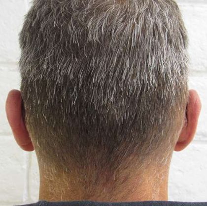 Ear Correction Before & After Patient #8373
