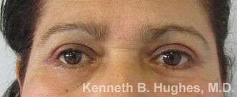 Eyelid Surgery Before & After Patient #8376