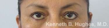 Eyelid Surgery Before & After Patient #8379