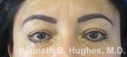 Eyelid Surgery Before & After Patient #8382