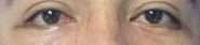 Eyelid Surgery Before & After Patient #8388
