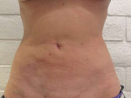 Abdomen Before & After Patient #5866