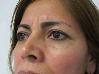 Eyelid Surgery Before & After Patient #8409