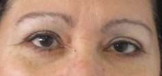 Eyelid Surgery Before & After Patient #8415