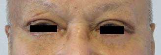 Eyelid Surgery Before & After Patient #8418