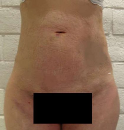 Bodytite Before & After Patient #6130