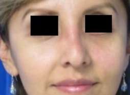 Eyelid Surgery Before & After Patient #8424