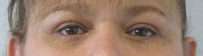 Eyelid Surgery Before & After Patient #8439