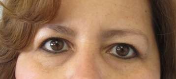 Eyelid Surgery Before & After Patient #8448