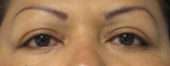Eyelid Surgery Before & After Patient #8451