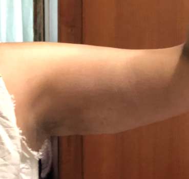 Bodytite Before & After Patient #6133