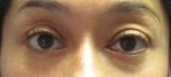 Eyelid Surgery Before & After Patient #8457