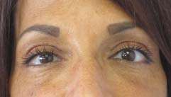Eyelid Surgery Before & After Patient #8460