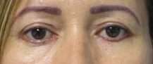 Eyelid Surgery Before & After Patient #8463