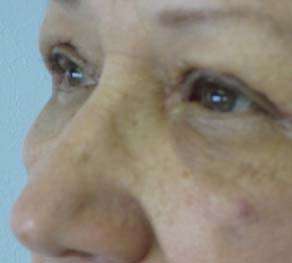 Eyelid Surgery Before & After Patient #8466