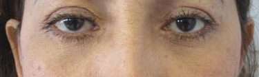 Eyelid Surgery Before & After Patient #8469
