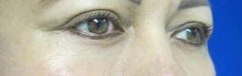 Eyelid Surgery Before & After Patient #8475