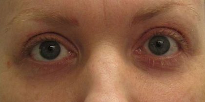 Eyelid Surgery Before & After Patient #8478