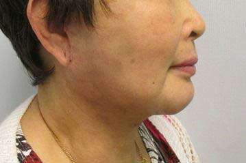 Facelift Before & After Patient #8484