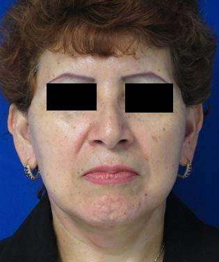 Facelift Before & After Patient #8492