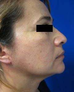 Facelift Before & After Patient #8511