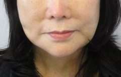 Facelift Before & After Patient #8514