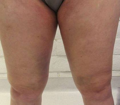 Bodytite Before & After Patient #6141
