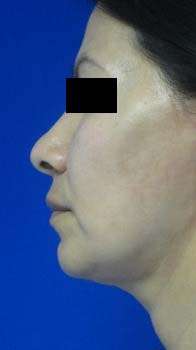Facelift Before & After Patient #8522
