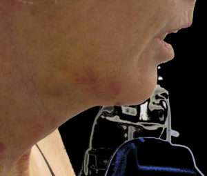 Facelift Before & After Patient #8527