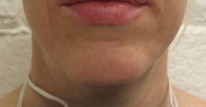 Facelift Before & After Patient #8534