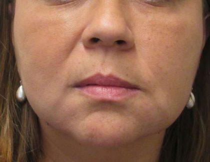Facetite Before & After Patient #8546