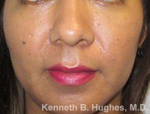 Facial Fat Grafting and Stem Cell Rejuvenation Before & After Patient #8549