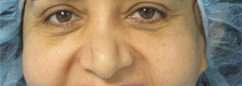 Facial Fat Grafting and Stem Cell Rejuvenation Before & After Patient #8557