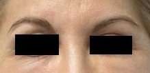 Facial Fat Grafting and Stem Cell Rejuvenation Before & After Patient #8560
