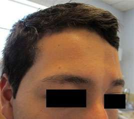 Facial Fat Grafting and Stem Cell Rejuvenation Before & After Patient #8566