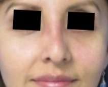 Facial Fat Grafting and Stem Cell Rejuvenation Before & After Patient #8569