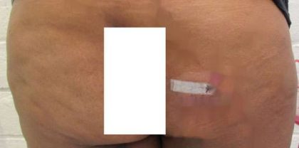 Fat Necrosis and Dead Fat Removal Before & After Patient #8579
